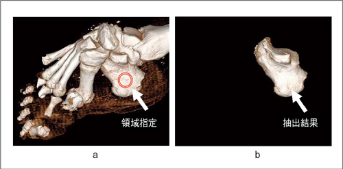 図3　汎用骨分離技術