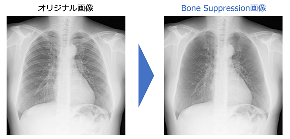 Bone Suppression処理（胸部骨減弱処理）