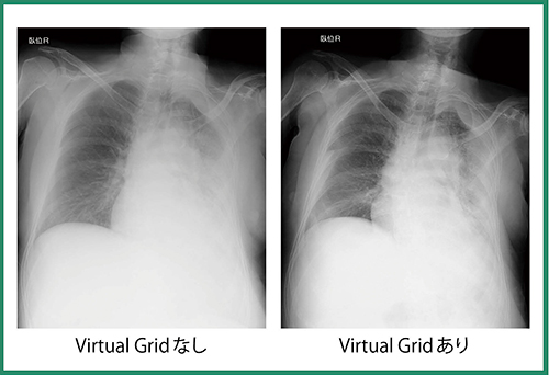 図2　Virtual Gridの有無による画像比較