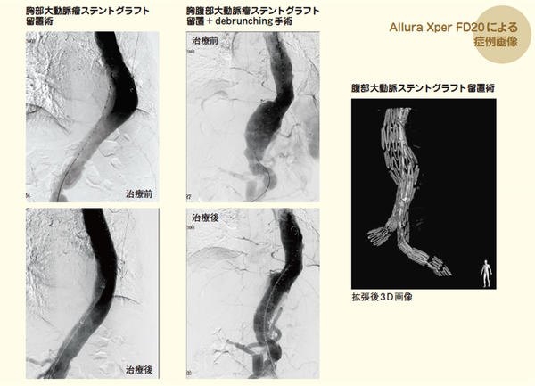 Allura Xper FD20による症例画像