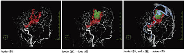 AVM症例の術前シミュレーション画像