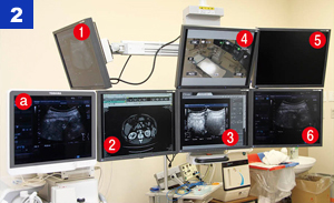 21型6面構成のモニタは天井懸垂で設置。モニタ全体の移動ができるほか，個々のモニタも方向が変えられるようになっている。 (1) 操作者用のリアルタイムBモード像　(2) 術前CT画像（電子カルテ）　 (3) 前日（または当日）の造影エコー像　　(4) 術者手元のライブ映像　(5) 患者バイタル　(6)リアルタイムBモード像　(a)：Aplio500のモニタ