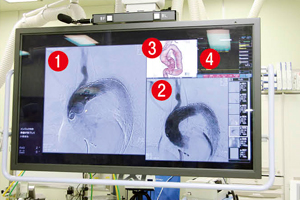 56インチモニタの画面構成例。透視画像(1)を一番大きく，次いで参照画像(2)，さらにVR像(3)と心電図(4)を表示。