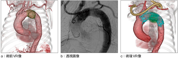 症例1 debranched TEVAR（弓部分枝へのバイパスを伴う胸部大動脈ステントグラフト内挿術）