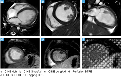 症例5：心筋症（1歳，男児）のシネMRI