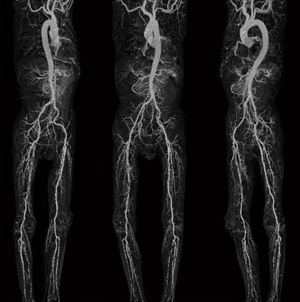 症例3：胸腹部下肢のMIP 画像（石灰化領域外す）