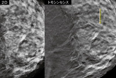 症例2：50歳代，女性，検診発見例