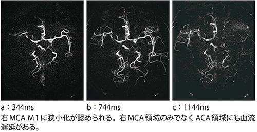 症例2：右頸動脈血栓内膜剥離術（CEA）後の“CINEMA-STAR”（非造影ダイナミックMRA，2分56秒）