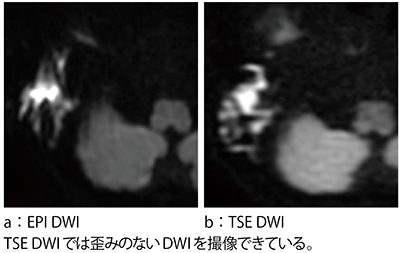 症例3：真珠腫のTSE DWI