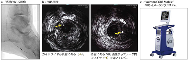 IVUS関連画像例：IVUS併用下肢インターベンションの画像例