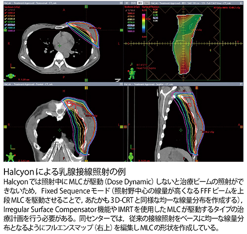 Halcyonによる乳腺接線照射の例