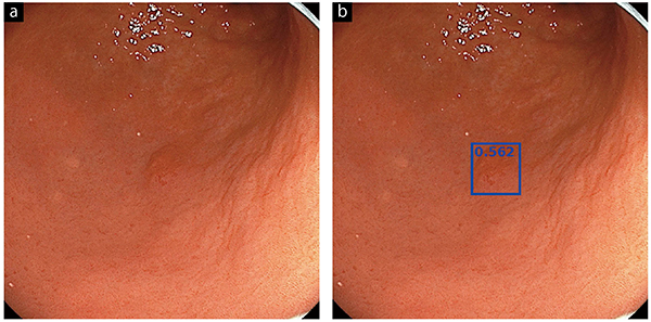 図1　上部内視鏡の画像に対して病変部分を検出 a：胃体部後壁の早期胃がんの白色光内視鏡画像 b：AIはがんの部分を正確に検出して青色の矩形で表示