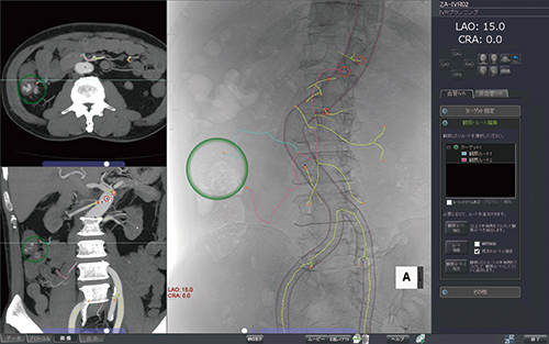 IVRプランニング CT画像を基に透視に似た画像を作成，血管を自動抽出して，救急などでの塞栓術を支援する。一刻を争いスピードと精度が要求される救急現場での要求に応え，臨床医の手技をサポートする。