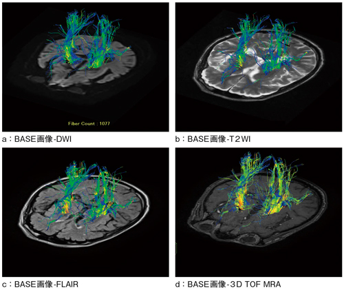 図4　異なるコントラスト画像と拡散テンソルとのフュージョン画像の応用例