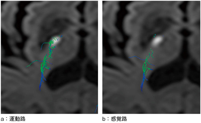 図8　DTI解析結果