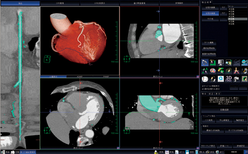 図1　冠動脈の自動セグメンテーション