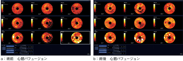 図6　CABG評価