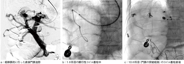 図3　経静脈的に行った直接門脈造影および血管塞栓