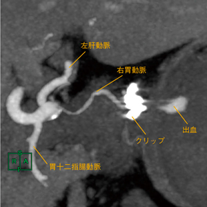 図2　slab MIP最大値表示 5mm厚としたことで，主要血管との関係や右胃動脈の変異，クリップから出血源までが明瞭に分離して表示できている