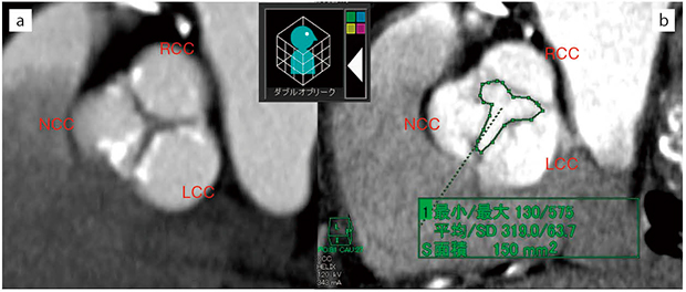 図2　症例1：“ダブルオブリーク”による器質性評価とAVA計測