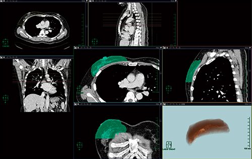 図1　乳房切除領域の設定