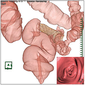 図2　大腸ステント治療後