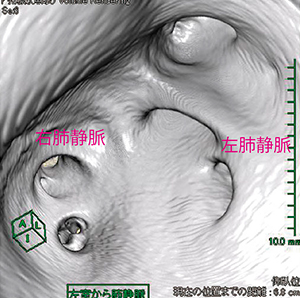 図4　仮想内視鏡応用例1