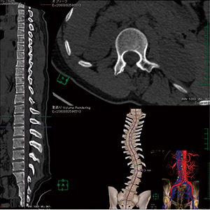 図9　脊柱側彎症術前評価