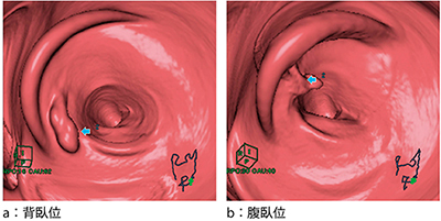 図3　2体位比較読影で背面側が固定された仮想内視鏡画像