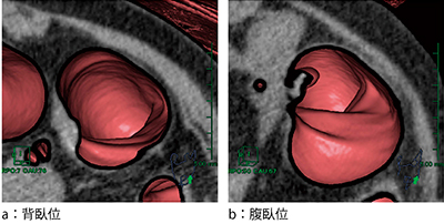 図5　2体位比較読影における仮想内視鏡MPR断面表示