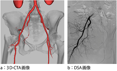 図2　IVRの術前3D-CTA画像とDSA画像