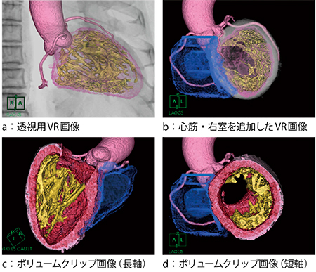 図5　左室内腔3DCT画像