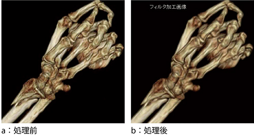 図4　症例1：スムージングノイズ除去フィルタの活用