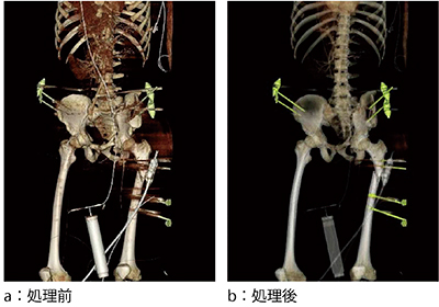 図5　症例2：創外固定具の確認