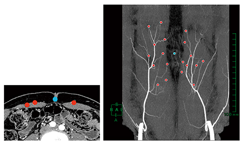 図5　マーキングした両下腹壁動脈MIP画像