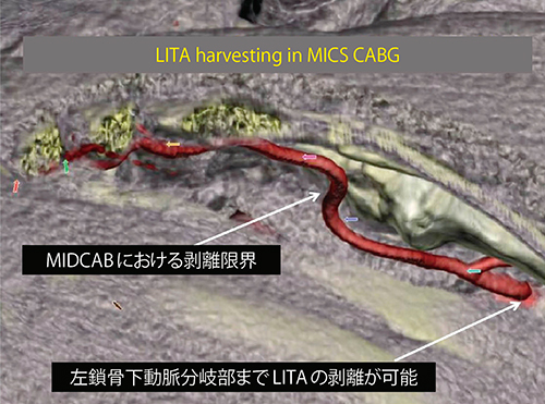 図1　MICS CABGとMIDCABの剥離限界点