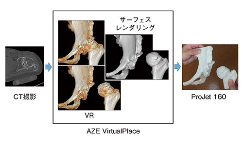 図3　THA術前モデル作製過程