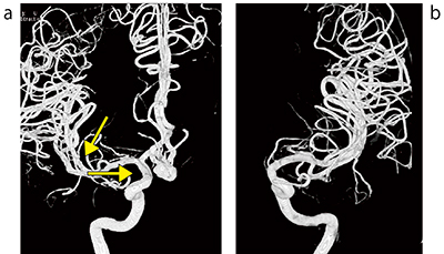 図4　症例：未破裂前交通動脈瘤