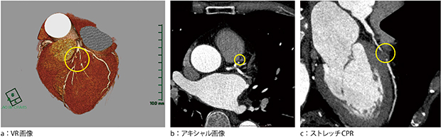 図3　冠動脈CTA ＃6に高度狭窄または完全閉塞を認める。