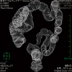 図1　仮想注腸像