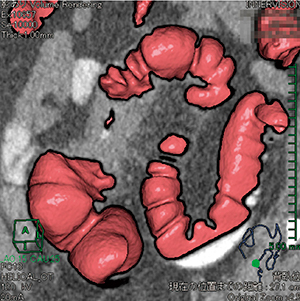 図3　仮想内視鏡＋MPR画像
