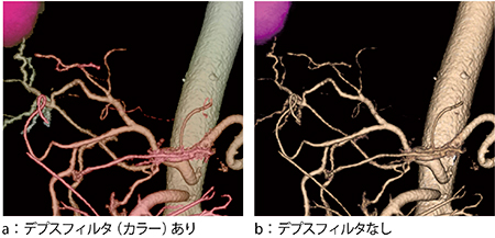 図6　デプスフィルタ（カラー）を使用した手術支援画像