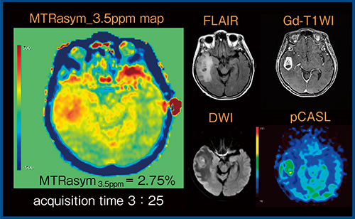 図1　膠芽腫のMTRasym_3.5ppm map（FASE2D）