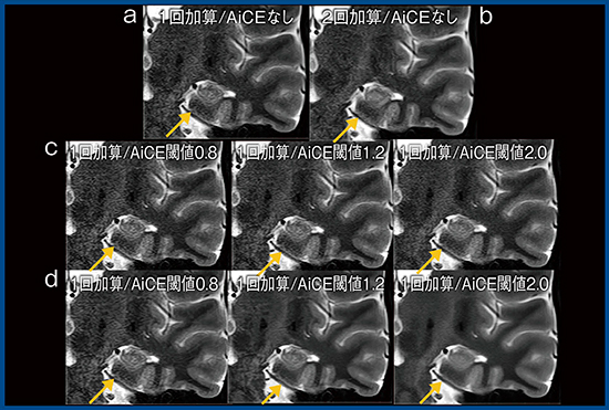 図1　AiCEによるT2強調冠状断像の撮像時間短縮 a：1回加算/AiCEなし　b：2回加算/AiCEなし c：1回加算/AiCE強度1　d：1回加算/AiCE強度5