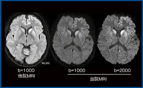 図6　高b値拡散強調画像によるクロイツフェルト・ヤコブ病の描出
