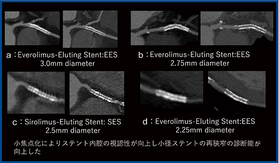 図1　従来CT（a〜ｄの左）とAquilion Precision（a〜ｄの右）による冠動脈の小径ステントの比較