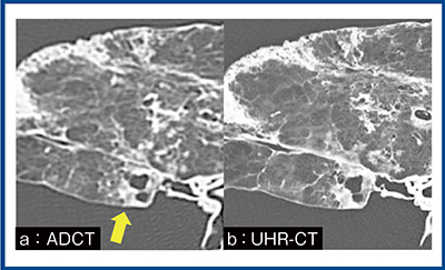 図1　びまん性汎細気管支炎における画像比較