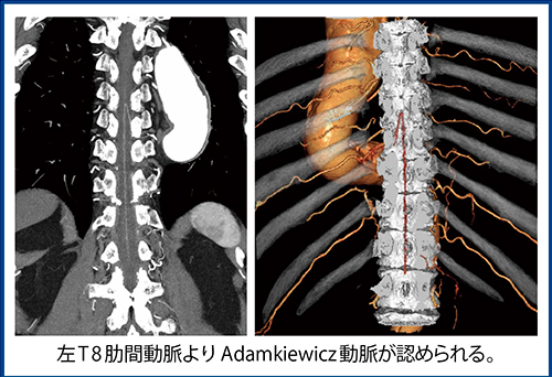 図3　症例3：TAAにおけるAdamkiewicz動脈の描出