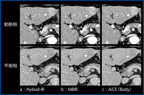 図1　Hybrid-IR，MBIR，AiCE（Body）の比較