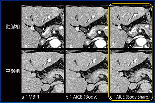 図2　MBIR，AiCE（Body），AiCE（Body Sharp）の比較 （図1と同一症例）